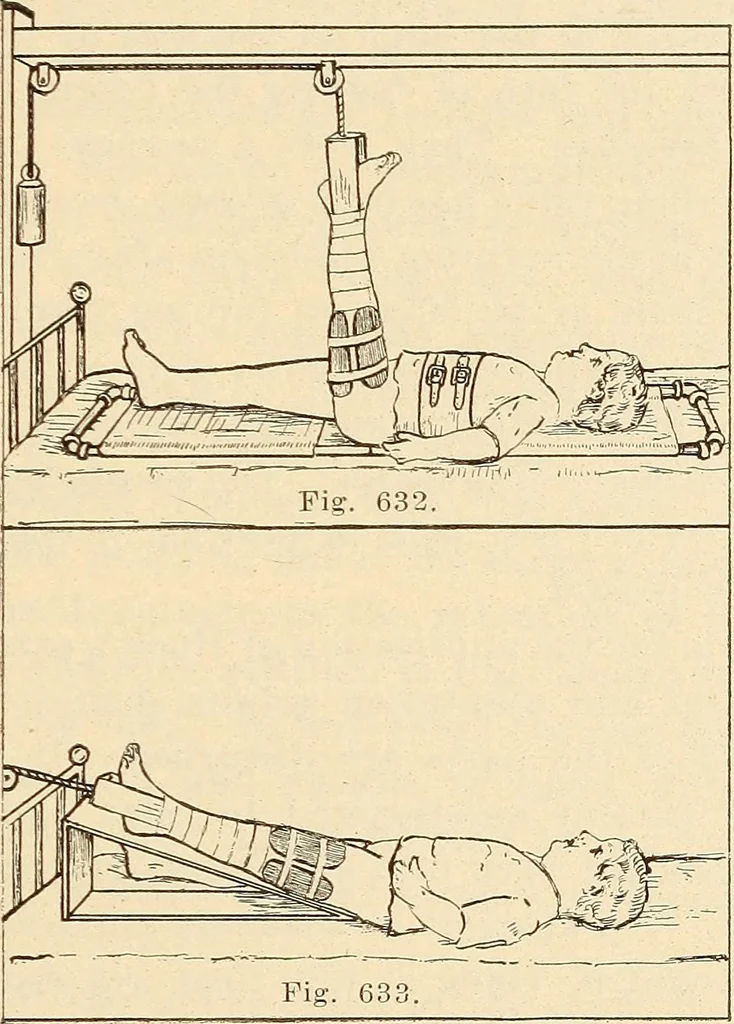 An illustration from Fractures and dislocations, diagnosis and treatment, 1915, leaf 596