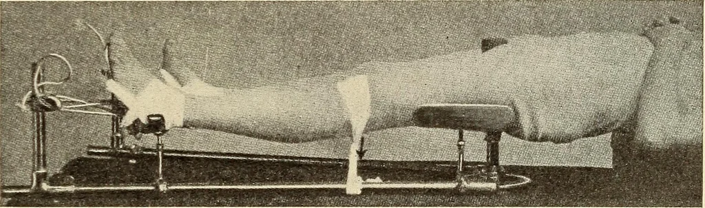 An illustration from Fractures and dislocations, diagnosis and treatment, 1915, leaf 600