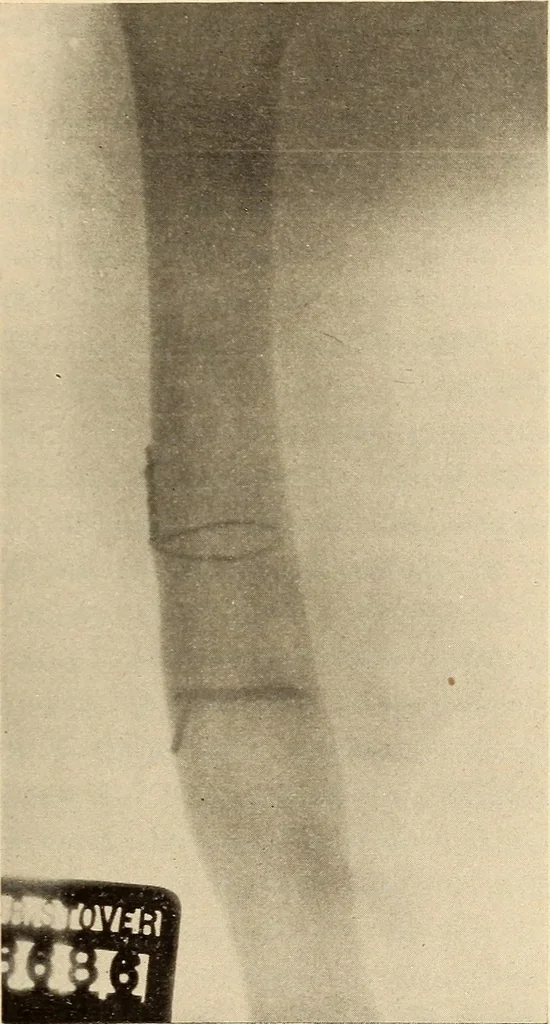 An illustration from Fractures and dislocations, diagnosis and treatment, 1915, leaf 602