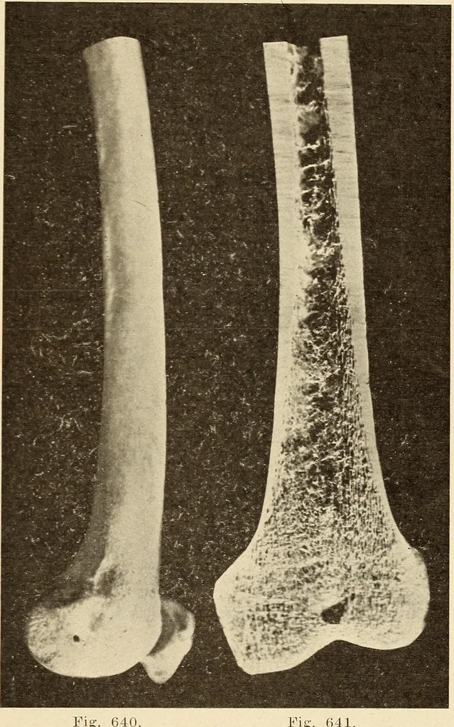 An illustration from Fractures and dislocations, diagnosis and treatment, 1915, leaf 606