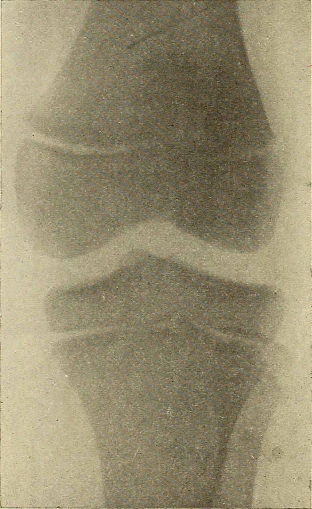 An illustration from Fractures and dislocations, diagnosis and treatment, 1915, leaf 607