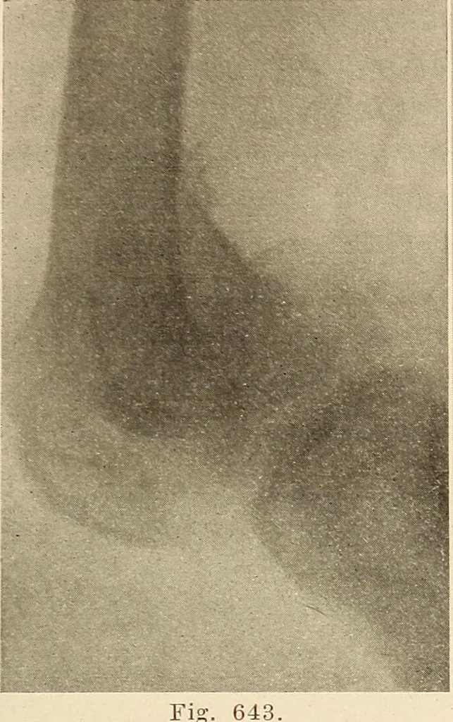 An illustration from Fractures and dislocations, diagnosis and treatment, 1915, leaf 608