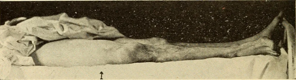 An illustration from Fractures and dislocations, diagnosis and treatment, 1915, leaf 609