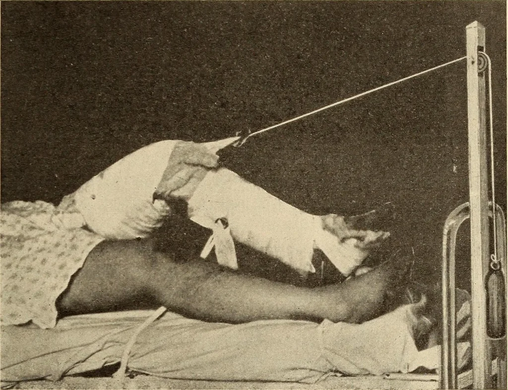 An illustration from Fractures and dislocations, diagnosis and treatment, 1915, leaf 612