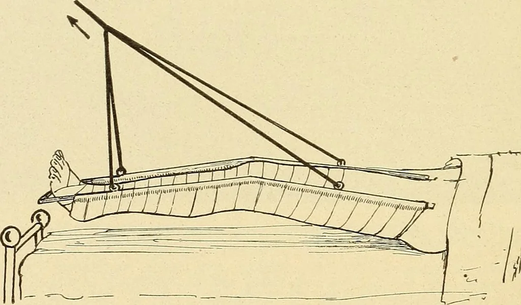 An illustration from Fractures and dislocations, diagnosis and treatment, 1915, leaf 613