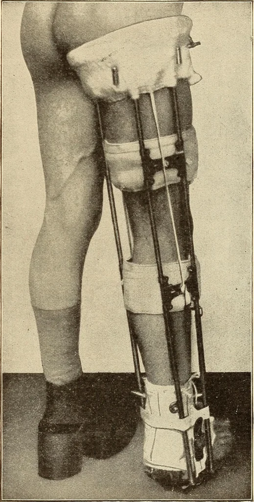 An illustration from Fractures and dislocations, diagnosis and treatment, 1915, leaf 616