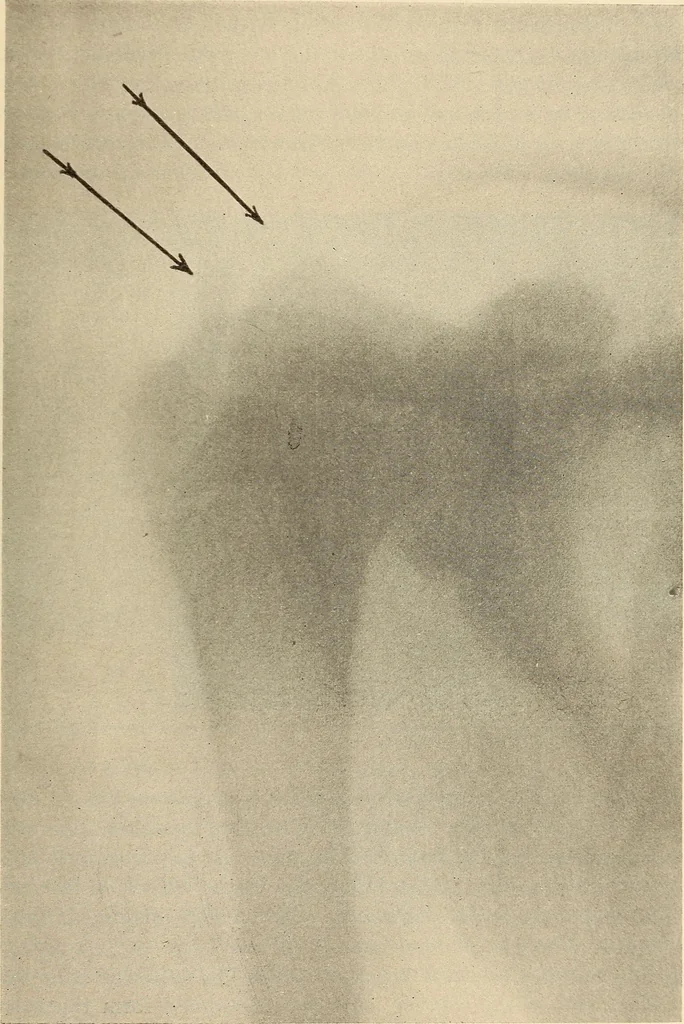 An illustration from Fractures and dislocations, diagnosis and treatment, 1915, leaf 62