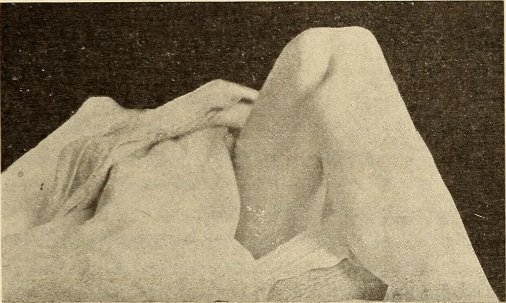 An illustration from Fractures and dislocations, diagnosis and treatment, 1915, leaf 620