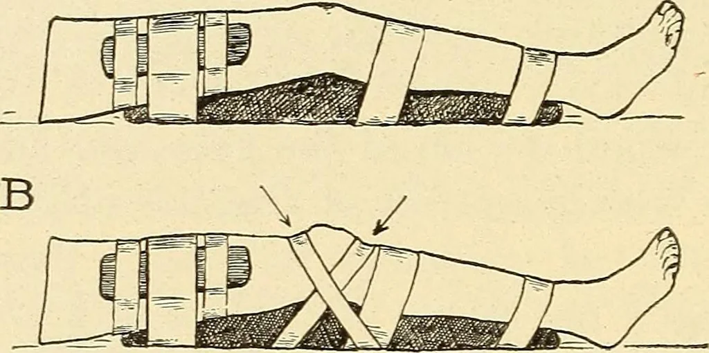 An illustration from Fractures and dislocations, diagnosis and treatment, 1915, leaf 629