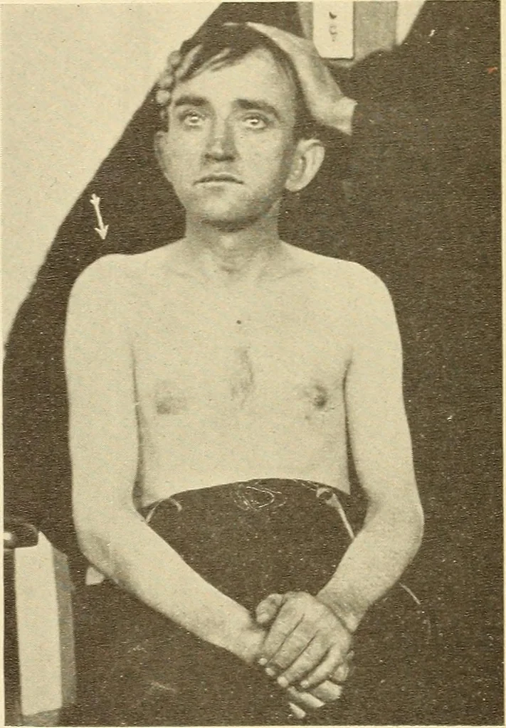 An illustration from Fractures and dislocations, diagnosis and treatment, 1915, leaf 63