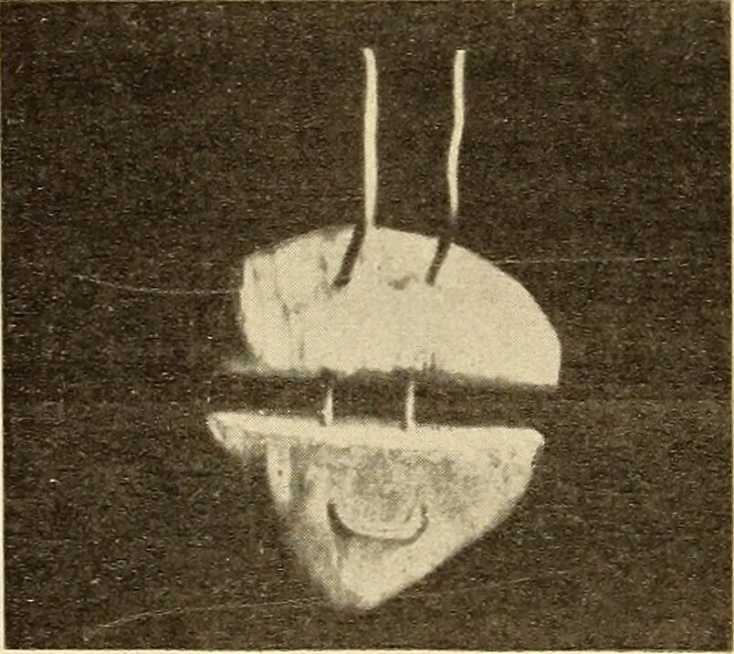 An illustration from Fractures and dislocations, diagnosis and treatment, 1915, leaf 631