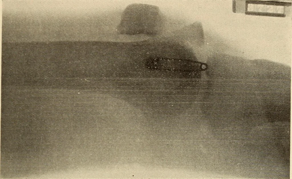 An illustration from Fractures and dislocations, diagnosis and treatment, 1915, leaf 632