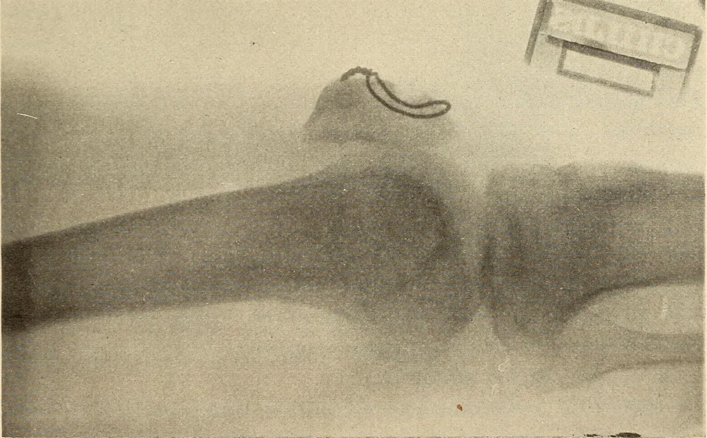 An illustration from Fractures and dislocations, diagnosis and treatment, 1915, leaf 632