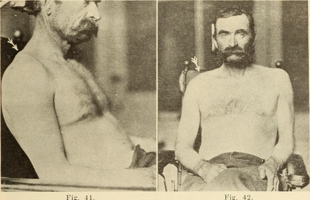 An illustration from Fractures and dislocations, diagnosis and treatment, 1915, leaf 64