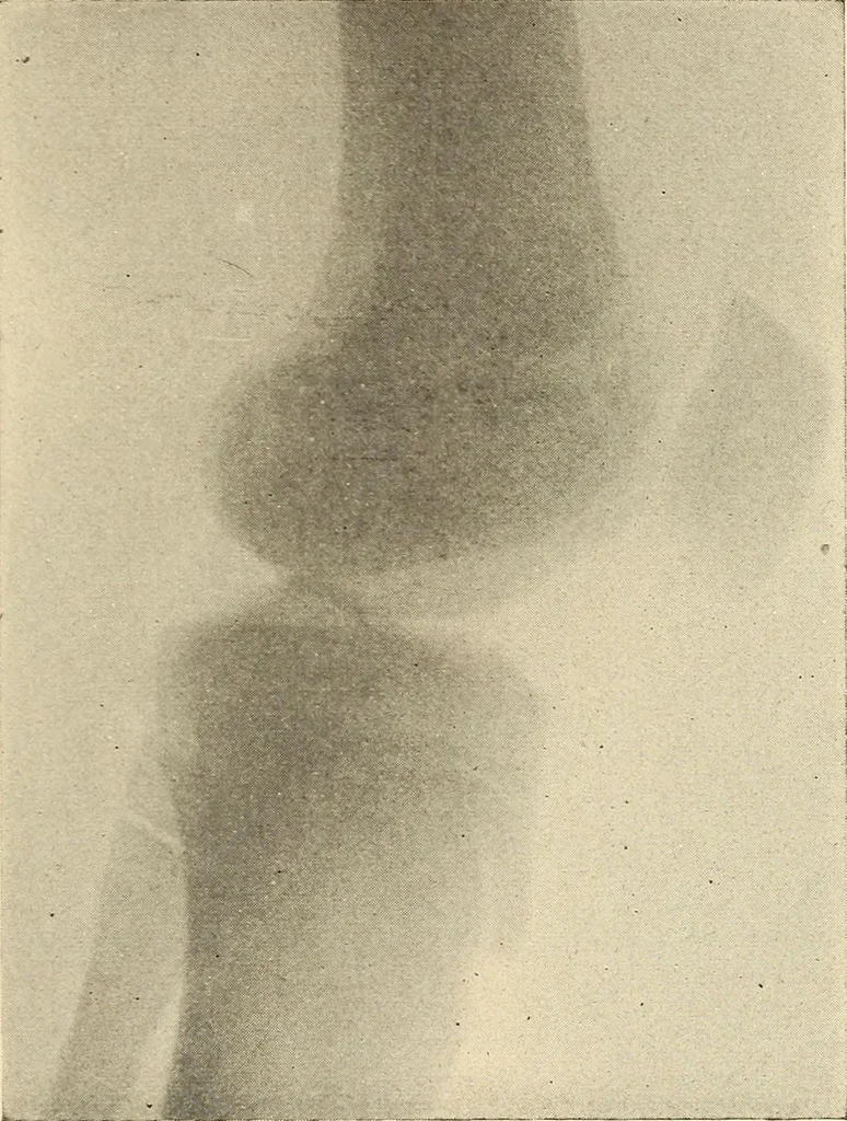 An illustration from Fractures and dislocations, diagnosis and treatment, 1915, leaf 650