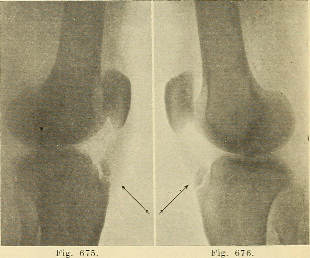 An illustration from Fractures and dislocations, diagnosis and treatment, 1915, leaf 651