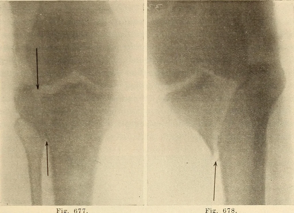 An illustration from Fractures and dislocations, diagnosis and treatment, 1915, leaf 652