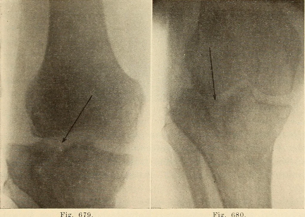 An illustration from Fractures and dislocations, diagnosis and treatment, 1915, leaf 652