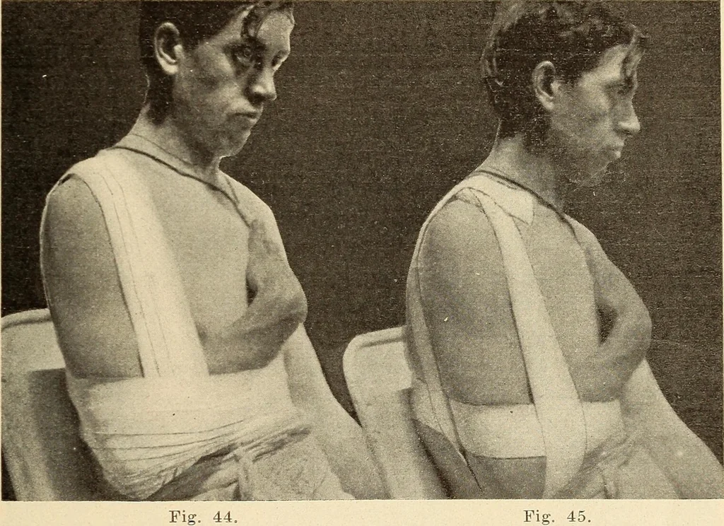 An illustration from Fractures and dislocations, diagnosis and treatment, 1915, leaf 66