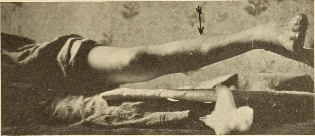 An illustration from Fractures and dislocations, diagnosis and treatment, 1915, leaf 668