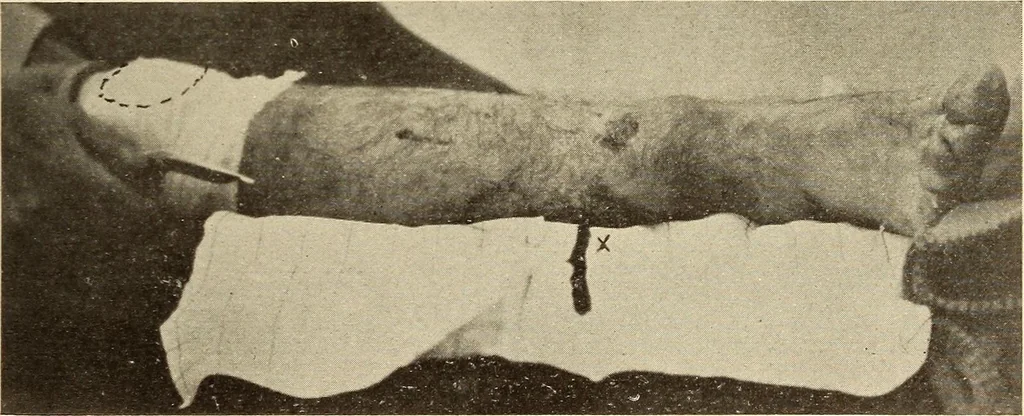 An illustration from Fractures and dislocations, diagnosis and treatment, 1915, leaf 668