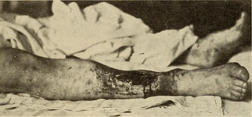 An illustration from Fractures and dislocations, diagnosis and treatment, 1915, leaf 670