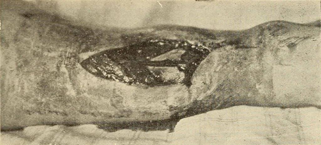 An illustration from Fractures and dislocations, diagnosis and treatment, 1915, leaf 670
