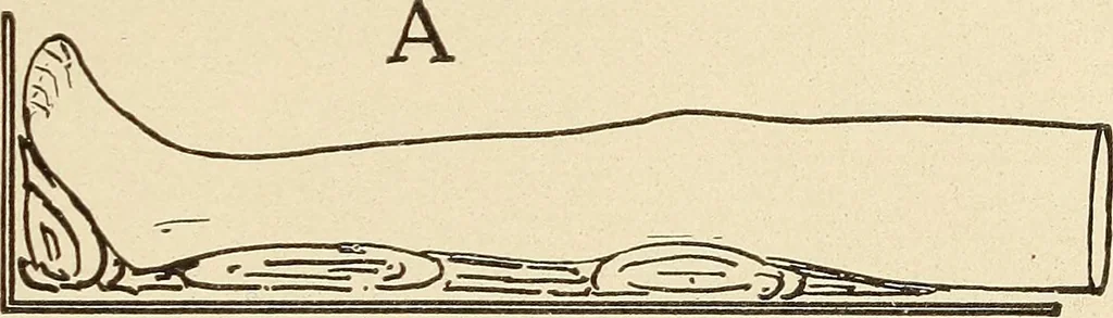 An illustration from Fractures and dislocations, diagnosis and treatment, 1915, leaf 672
