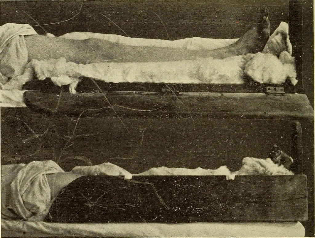 An illustration from Fractures and dislocations, diagnosis and treatment, 1915, leaf 673