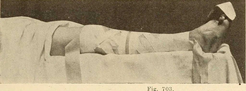 An illustration from Fractures and dislocations, diagnosis and treatment, 1915, leaf 674