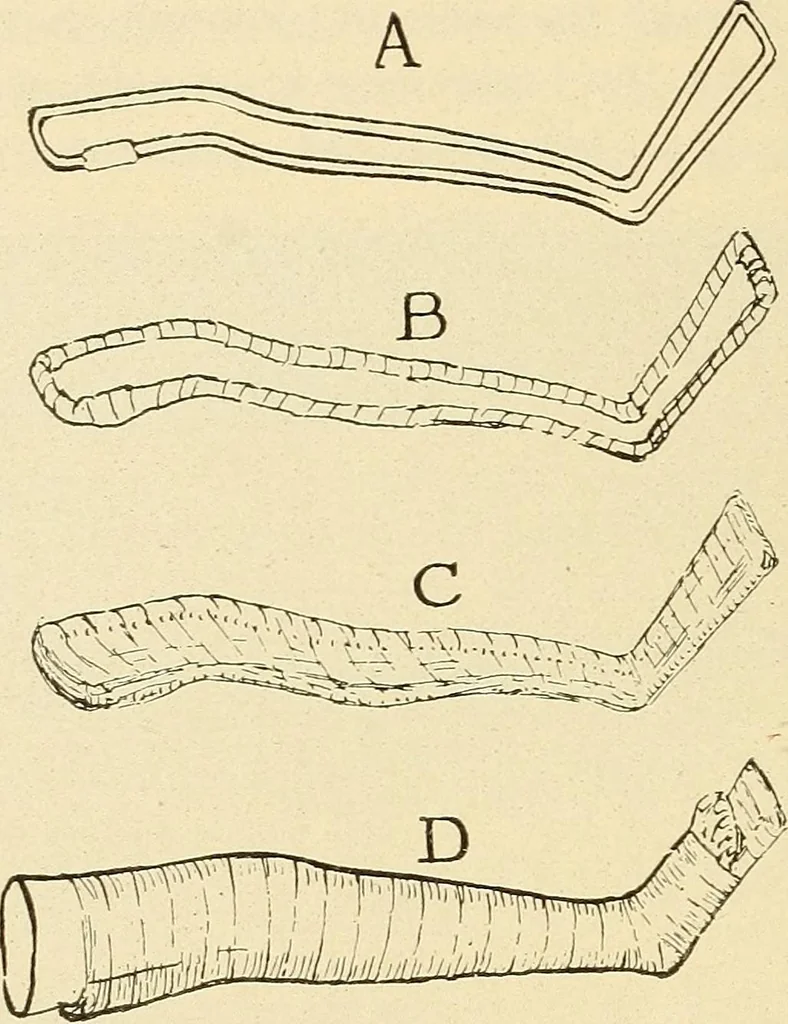 An illustration from Fractures and dislocations, diagnosis and treatment, 1915, leaf 675