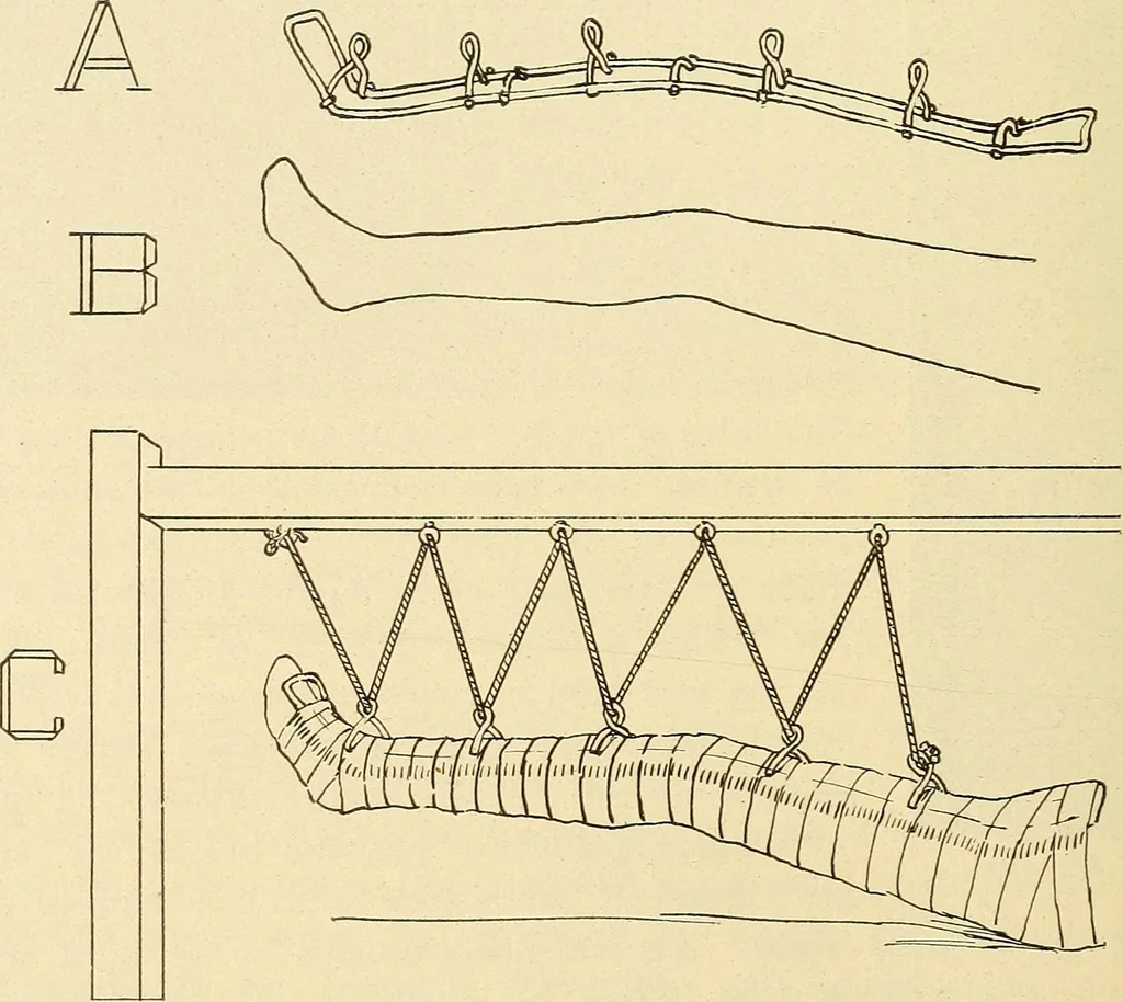 An illustration from Fractures and dislocations, diagnosis and treatment, 1915, leaf 675