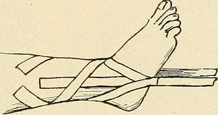 An illustration from Fractures and dislocations, diagnosis and treatment, 1915, leaf 676