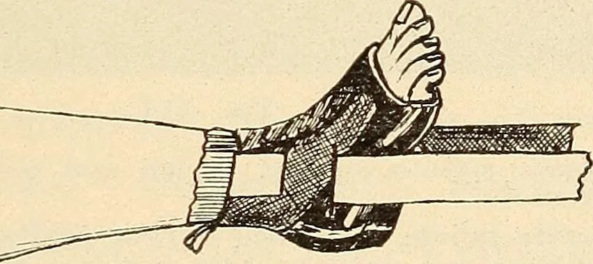 An illustration from Fractures and dislocations, diagnosis and treatment, 1915, leaf 676