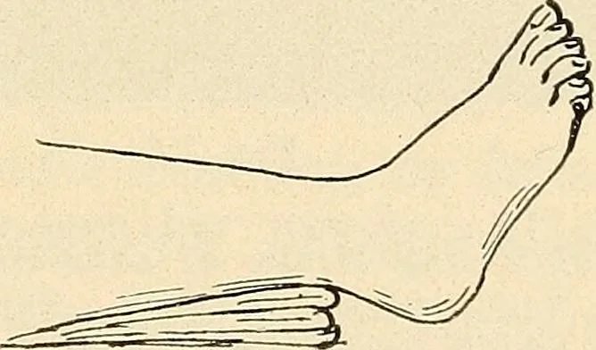 An illustration from Fractures and dislocations, diagnosis and treatment, 1915, leaf 676