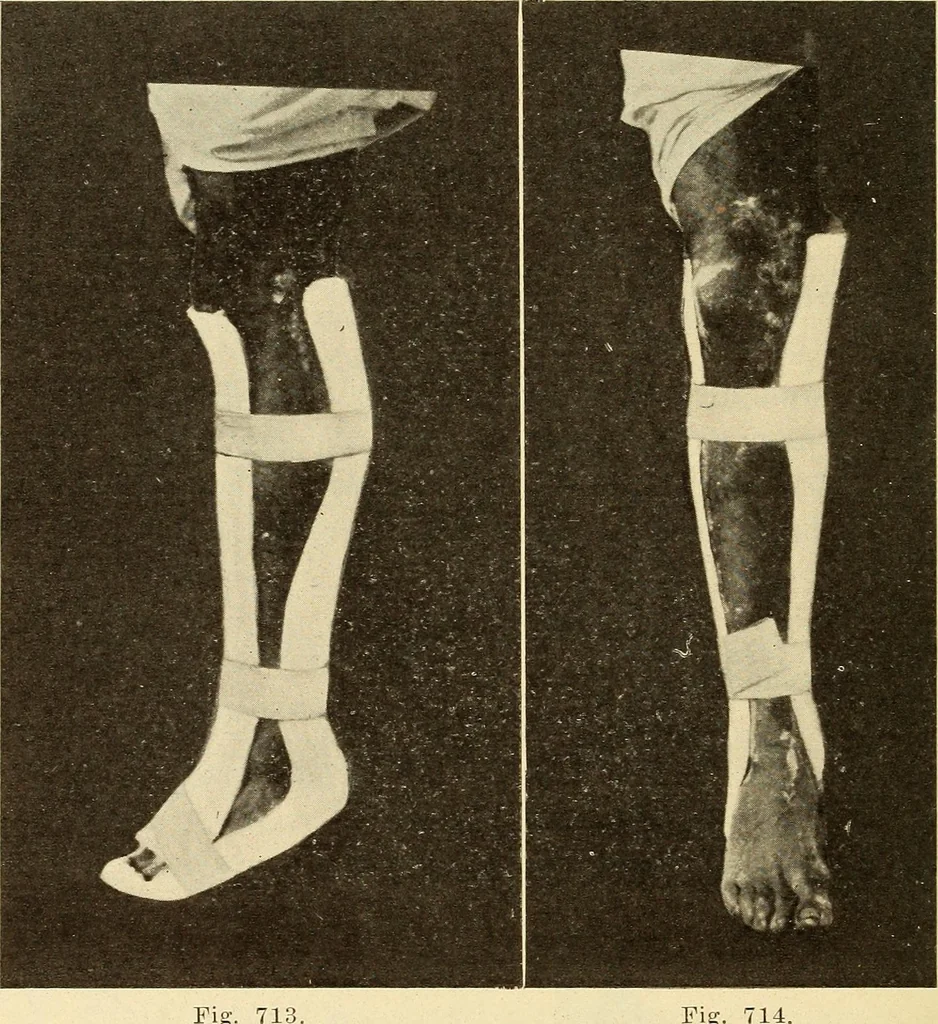 An illustration from Fractures and dislocations, diagnosis and treatment, 1915, leaf 677