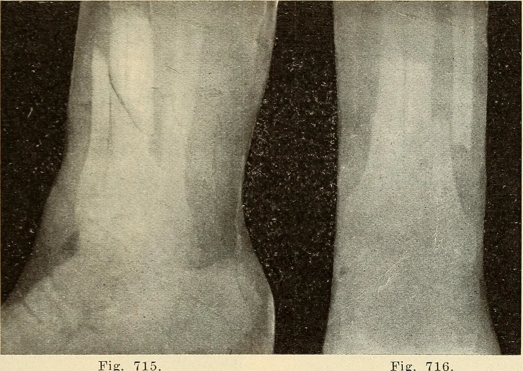 An illustration from Fractures and dislocations, diagnosis and treatment, 1915, leaf 680
