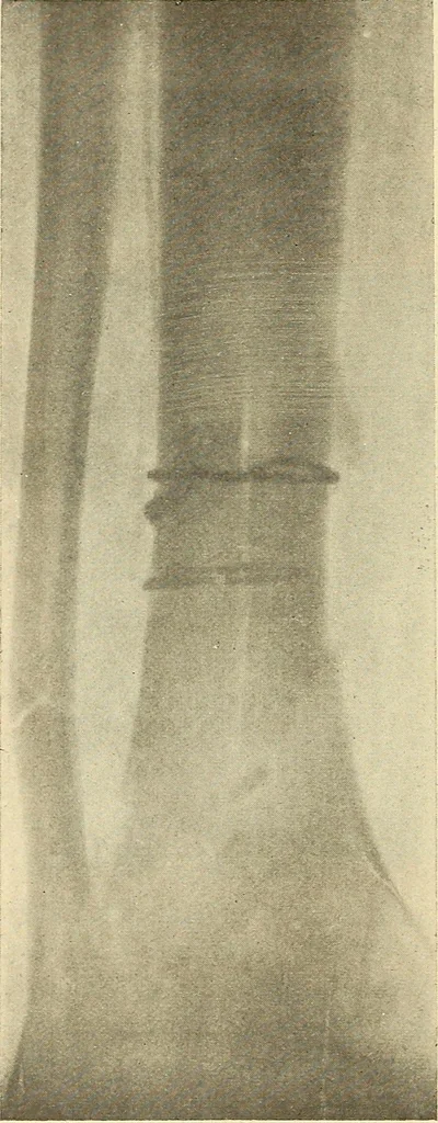 An illustration from Fractures and dislocations, diagnosis and treatment, 1915, leaf 681