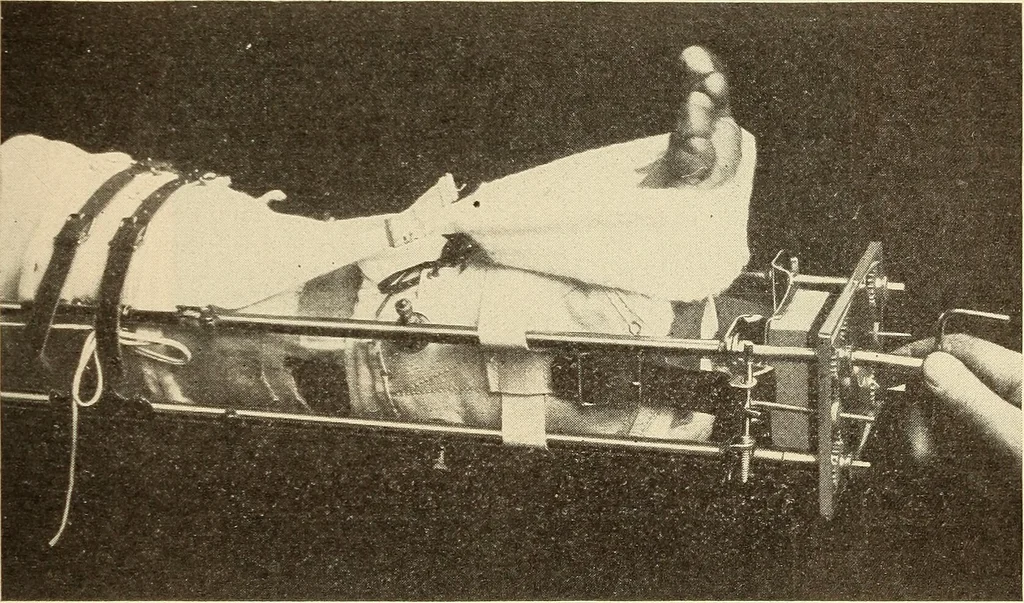 An illustration from Fractures and dislocations, diagnosis and treatment, 1915, leaf 684