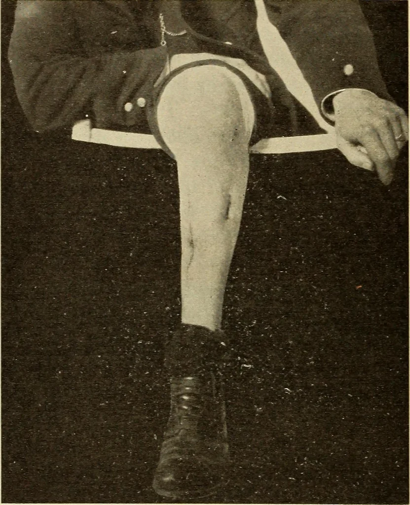 An illustration from Fractures and dislocations, diagnosis and treatment, 1915, leaf 685