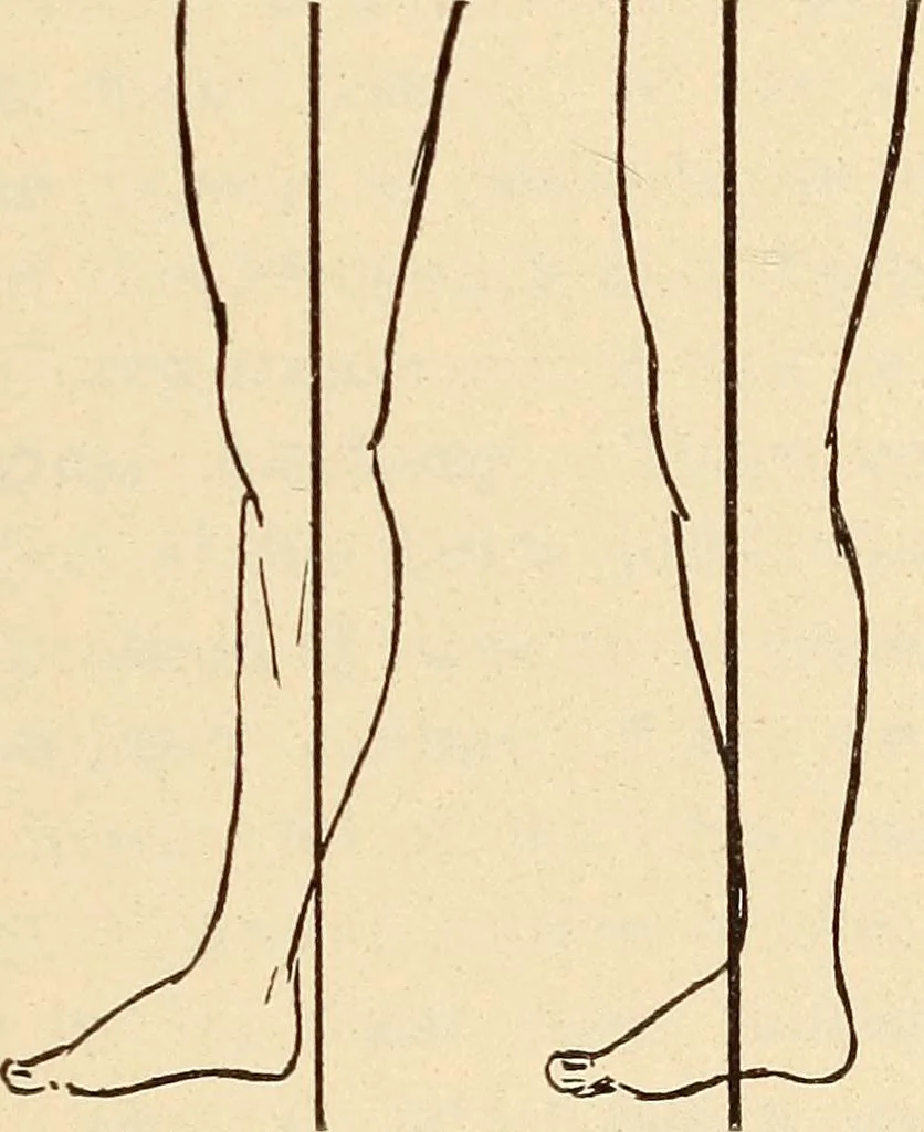 An illustration from Fractures and dislocations, diagnosis and treatment, 1915, leaf 686