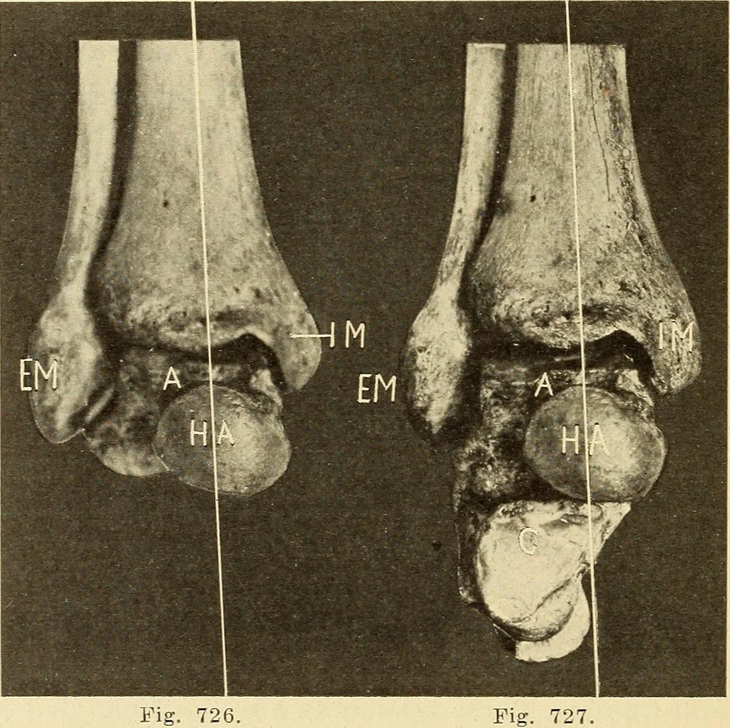 An illustration from Fractures and dislocations, diagnosis and treatment, 1915, leaf 689