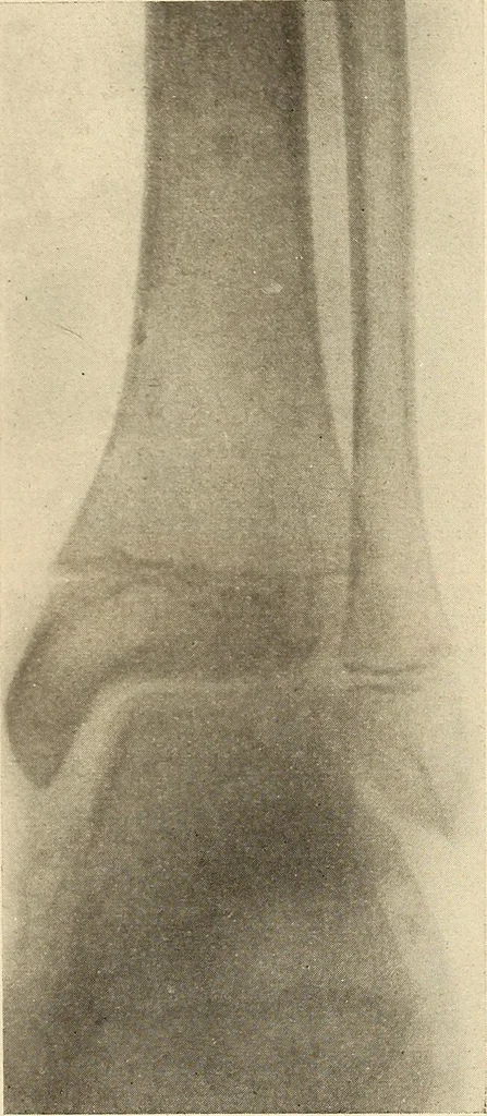 An illustration from Fractures and dislocations, diagnosis and treatment, 1915, leaf 690