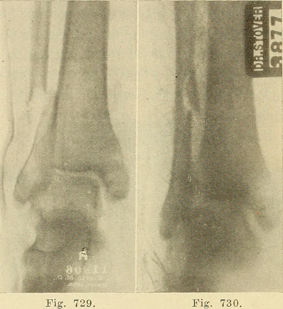 An illustration from Fractures and dislocations, diagnosis and treatment, 1915, leaf 691