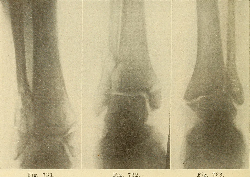 An illustration from Fractures and dislocations, diagnosis and treatment, 1915, leaf 691