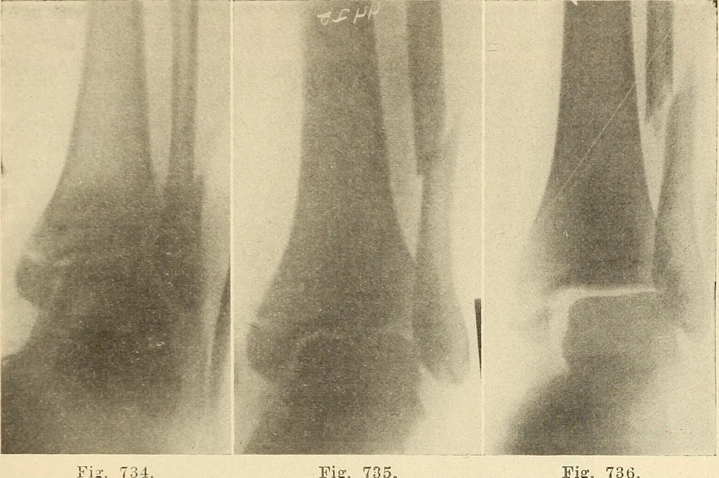 An illustration from Fractures and dislocations, diagnosis and treatment, 1915, leaf 692