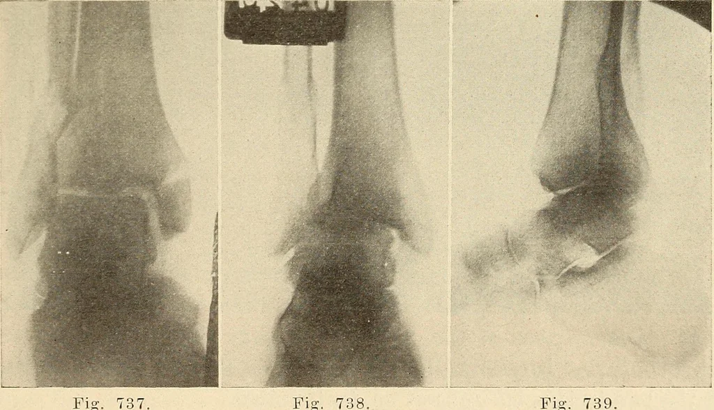 An illustration from Fractures and dislocations, diagnosis and treatment, 1915, leaf 692