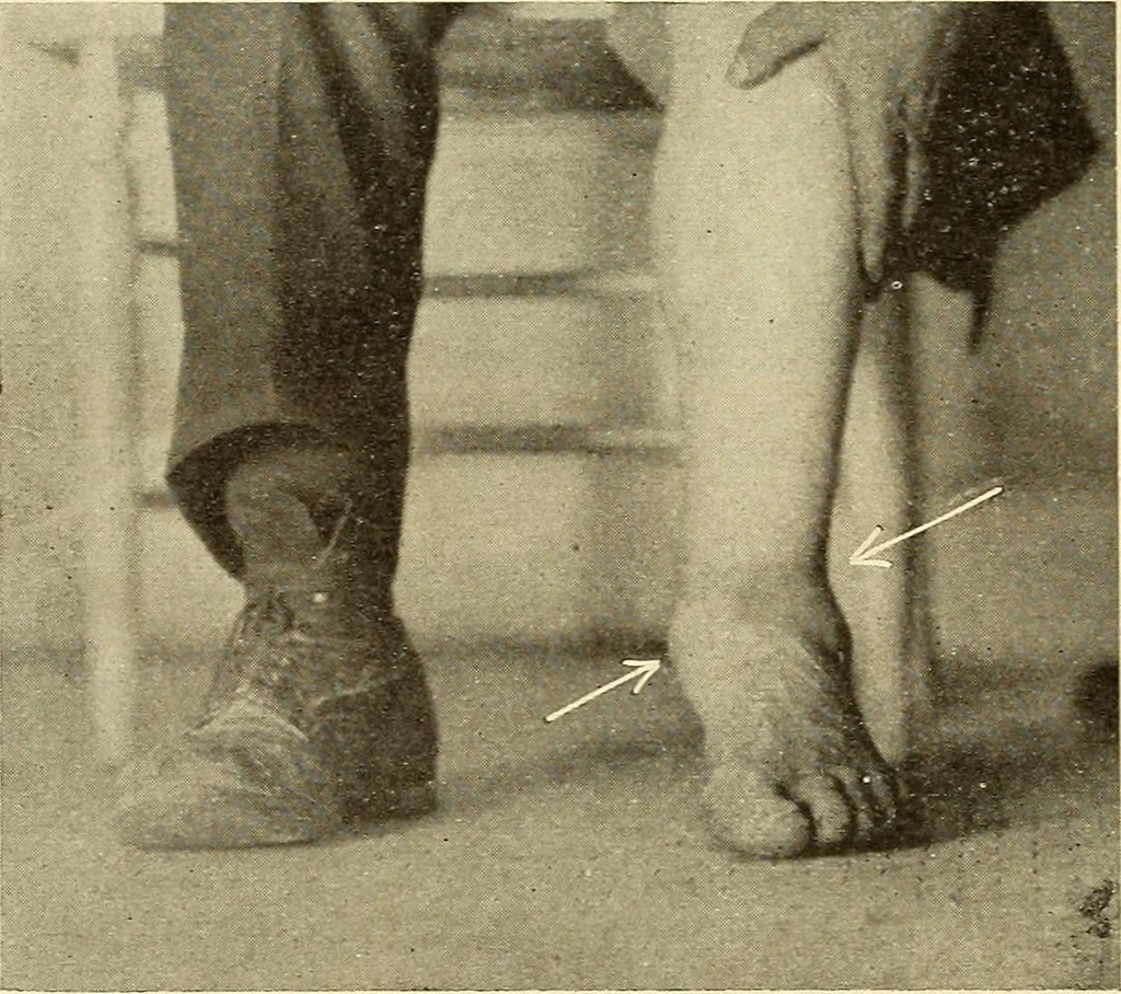 An illustration from Fractures and dislocations, diagnosis and treatment, 1915, leaf 693