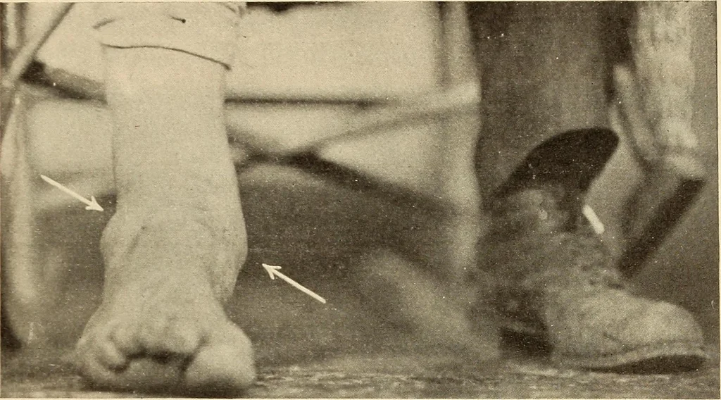 An illustration from Fractures and dislocations, diagnosis and treatment, 1915, leaf 694