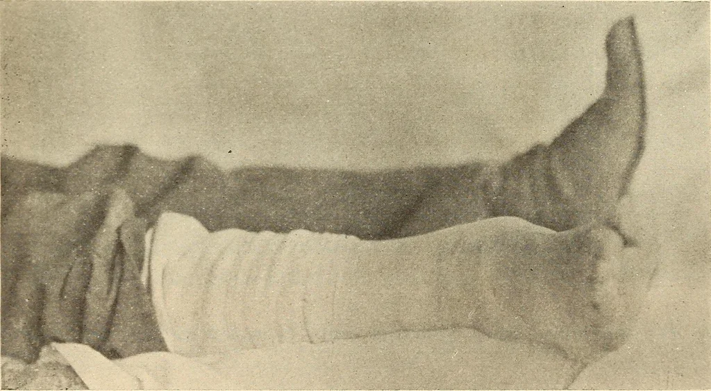 An illustration from Fractures and dislocations, diagnosis and treatment, 1915, leaf 694